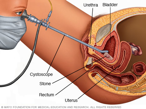 suprapubic catheter complications