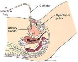 suprapubic-catheter