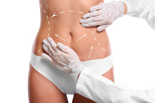 liposuction definition