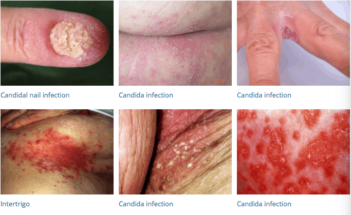 Cutaneous Candidiasis