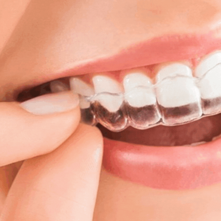 5 Reasons to Choose Invisible Aligners