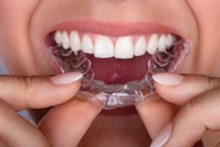 clear aligners