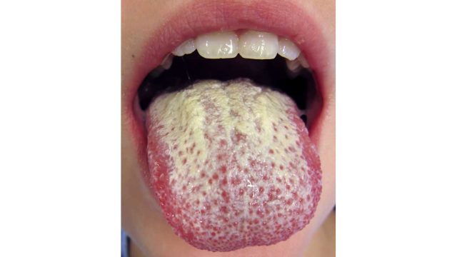 Oral Yeast Infections