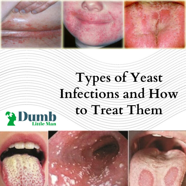 Types of Yeast Infections and How to Treat Them