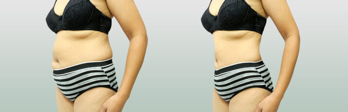 The Emergence of Coolsculpting