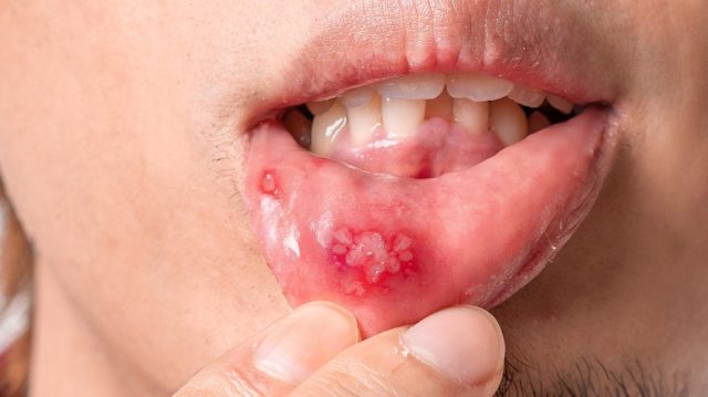 Symptoms of Mouth Sores and Inflammation