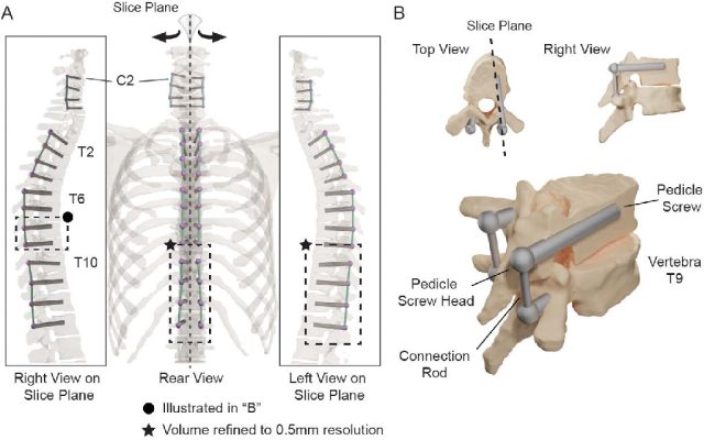 Spinal Implants & Improving Tools