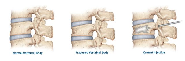 Vertebral Augmentation