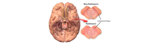 parkinsons protocol reviews