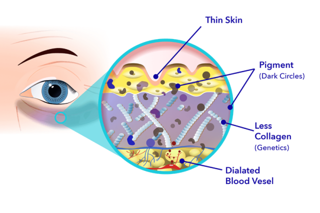 what causes dark circles under eyes