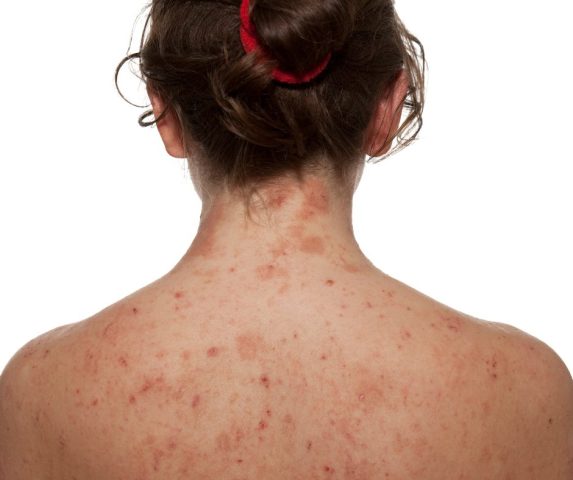 what causes eczema flare ups