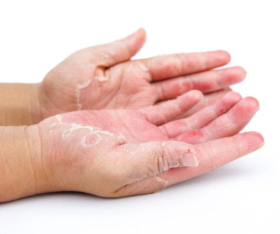 what causes eczema flare ups
