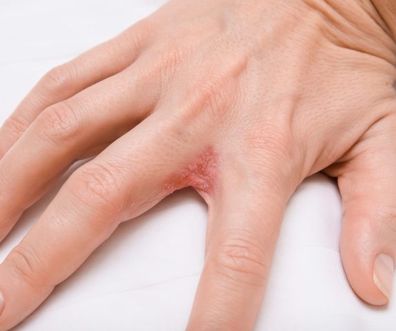 what causes eczema flare ups