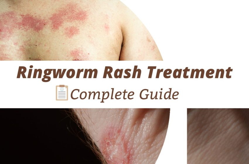  Ringworm Rash Treatment: Complete Guide 2023