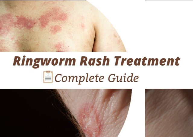 ringworm rash