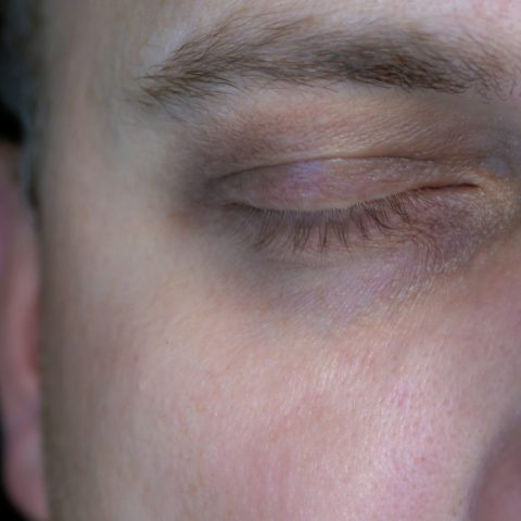 what causes dark circles under eyes