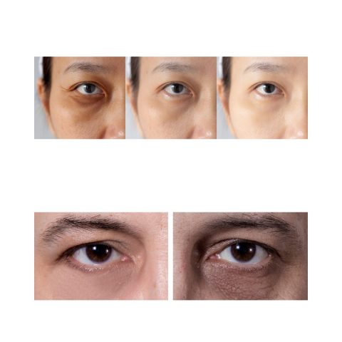 what causes dark circles under eyes