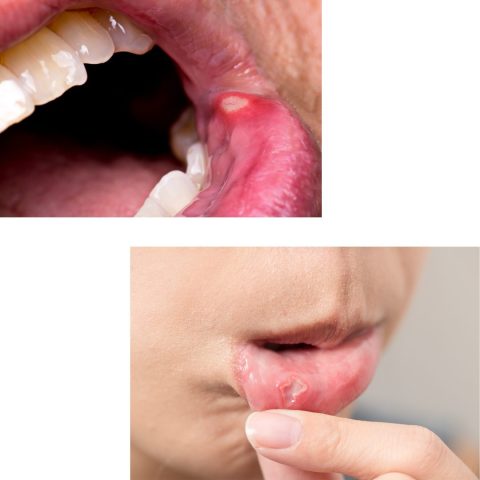 Mouth sores