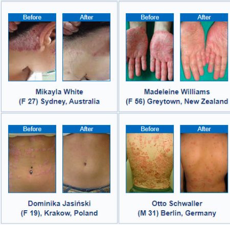 psoriasis revolution reviews