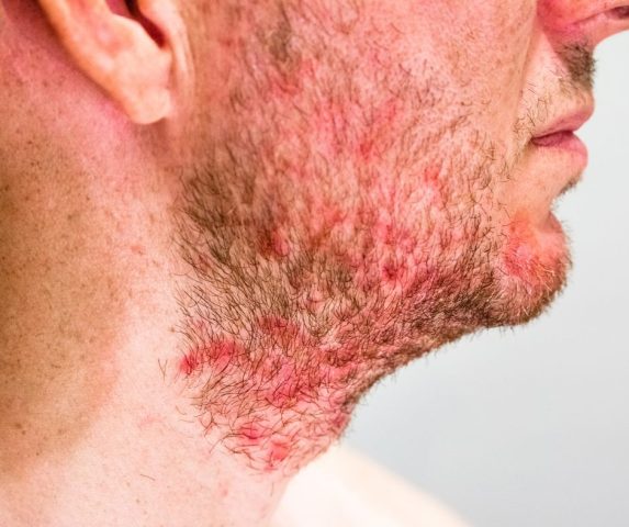 what causes eczema flare ups