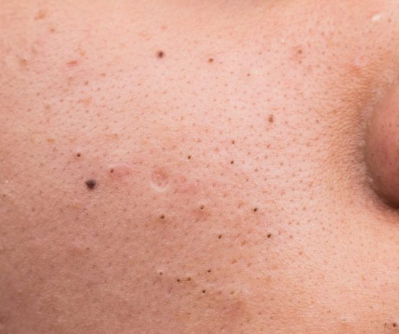 how to get rid of blackheads