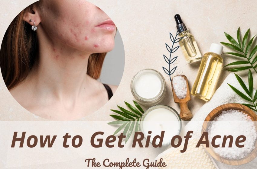  How to Get Rid of Acne : The Complete Guide 2023