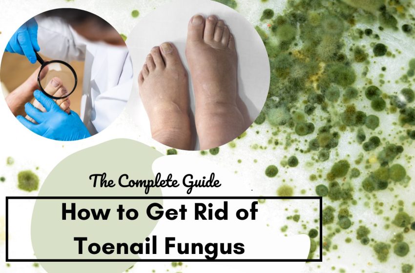  How To Get Rid of Toenail Fungus : The Complete Guide 2023