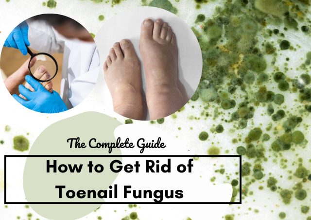 how to get rid of toenail fungus
