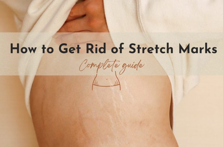  How to Get Rid of Stretch Marks: Complete Guide 2023