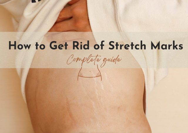 how to get rid of stretch marks