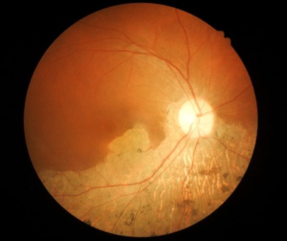 macular degeneration