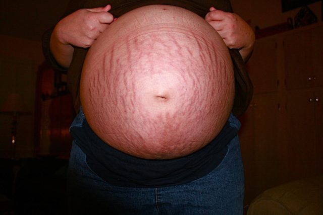 pregnancy stretch marks