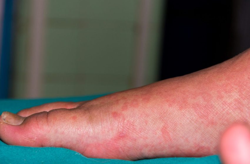  3 Ways To Treat Idiopathic Urticaria: Complete Guide 2023
