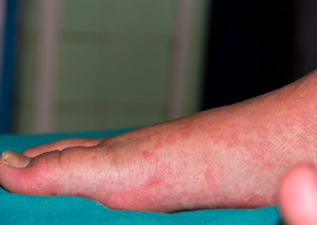 Idiopathic Urticaria