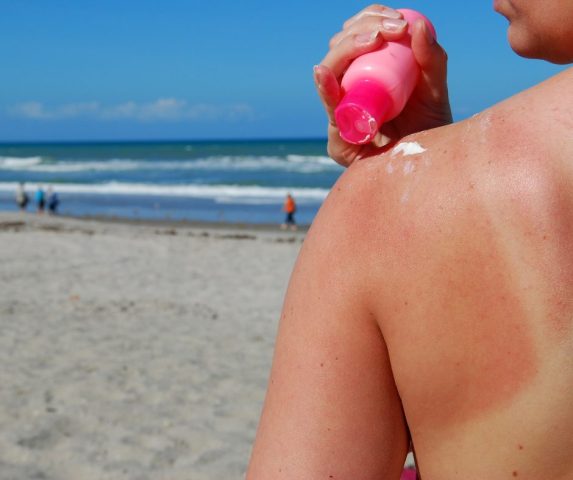 how to get rid of sunburn