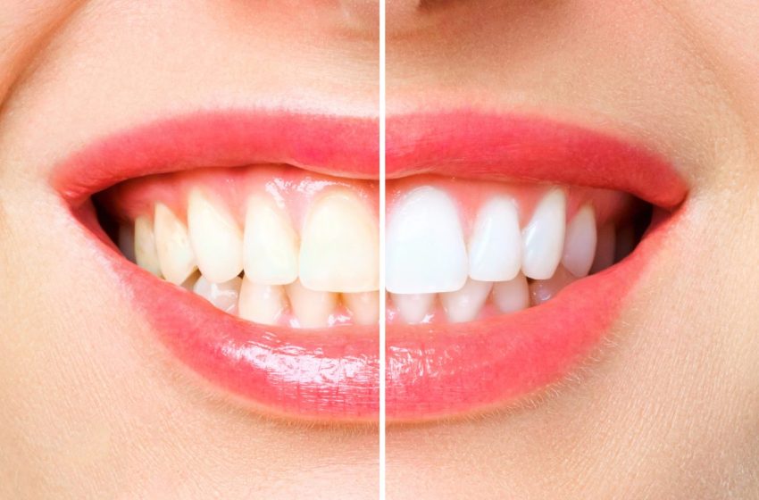  9 Best Teeth Whitening Products • Top Teeth Whiteners of 2023