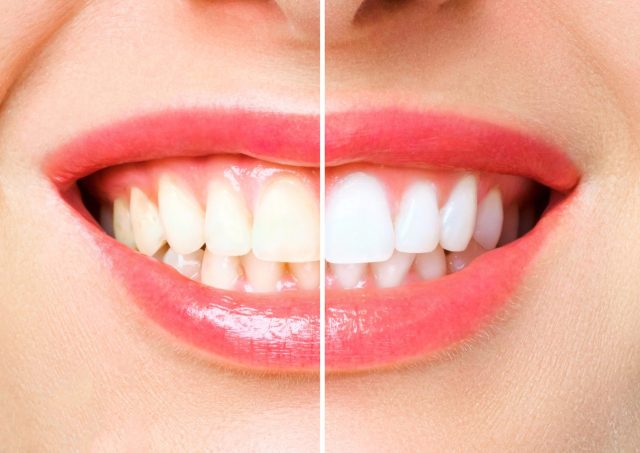 best teeth whitening