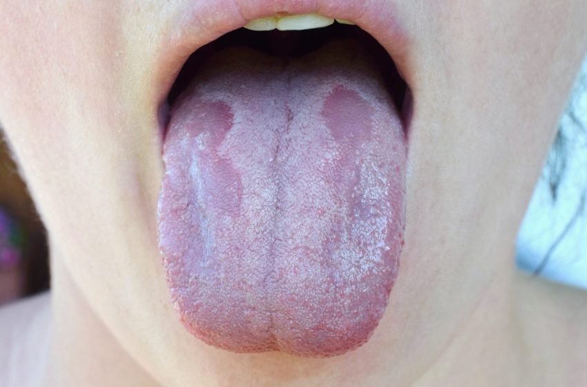  4 Ways to Get Rid of a Candida Rash: Complete Guide 2023