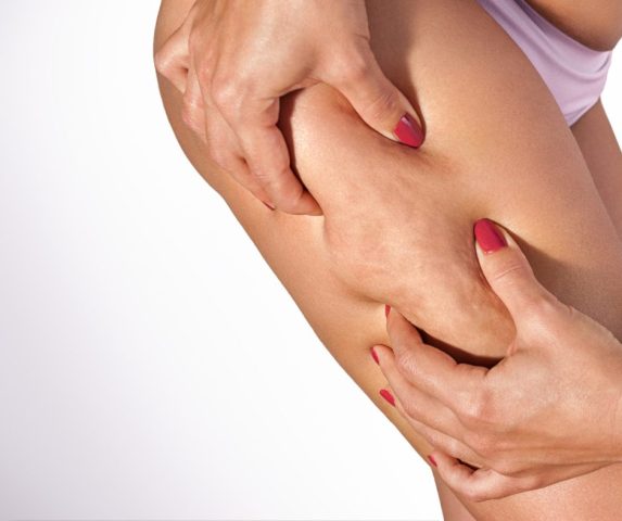 how to get rid of cellulite