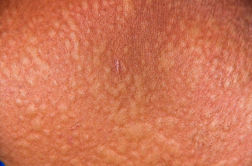  The Dangers of Untreated Cold Urticaria: Complete Guide 2023