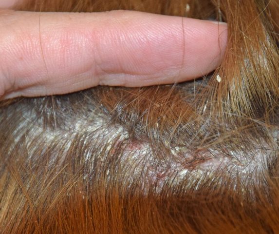 scalp psoriasis