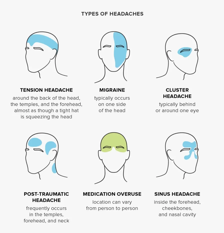 Cluster Headaches