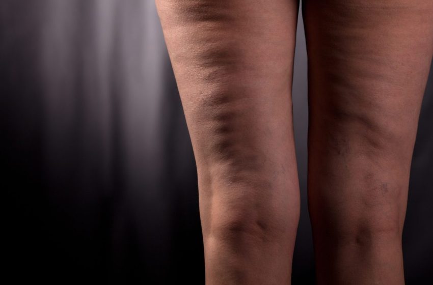  How to Get Rid of Cellulite for Good: Complete Guide 2023