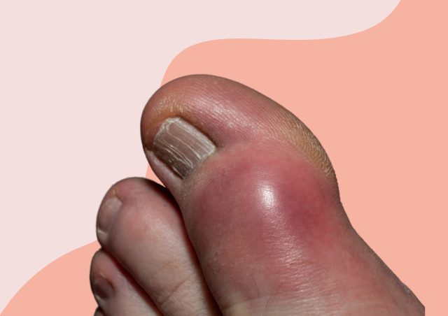 how to get rid of gout