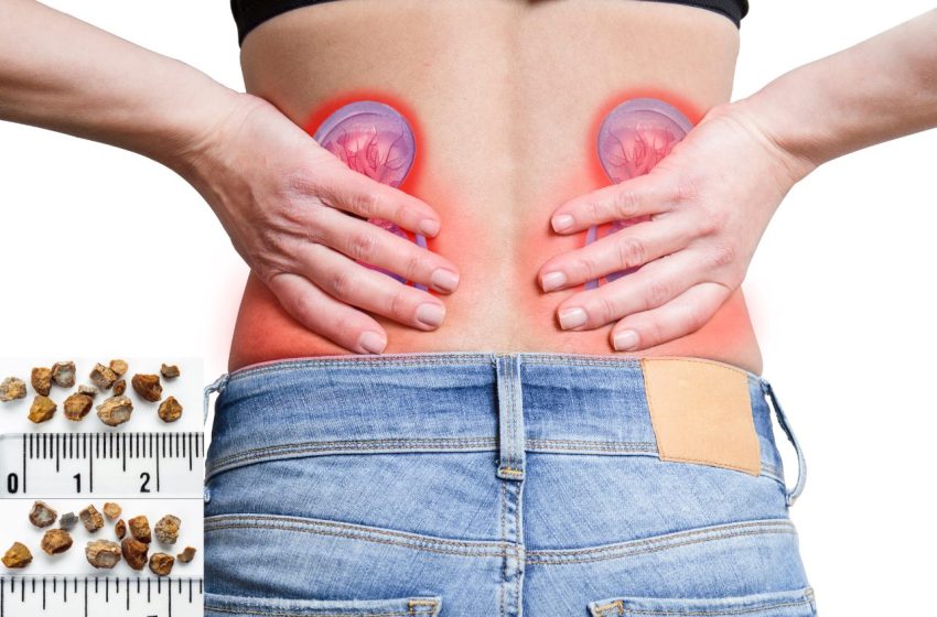 How to Prevent Kidney Stones: Complete Guide 2023