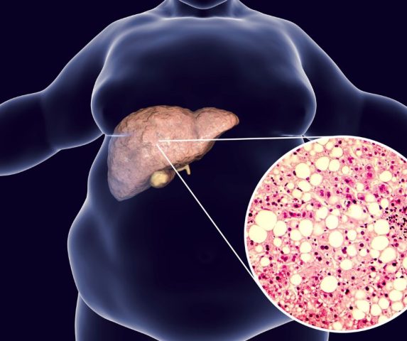 how to reverse fatty liver