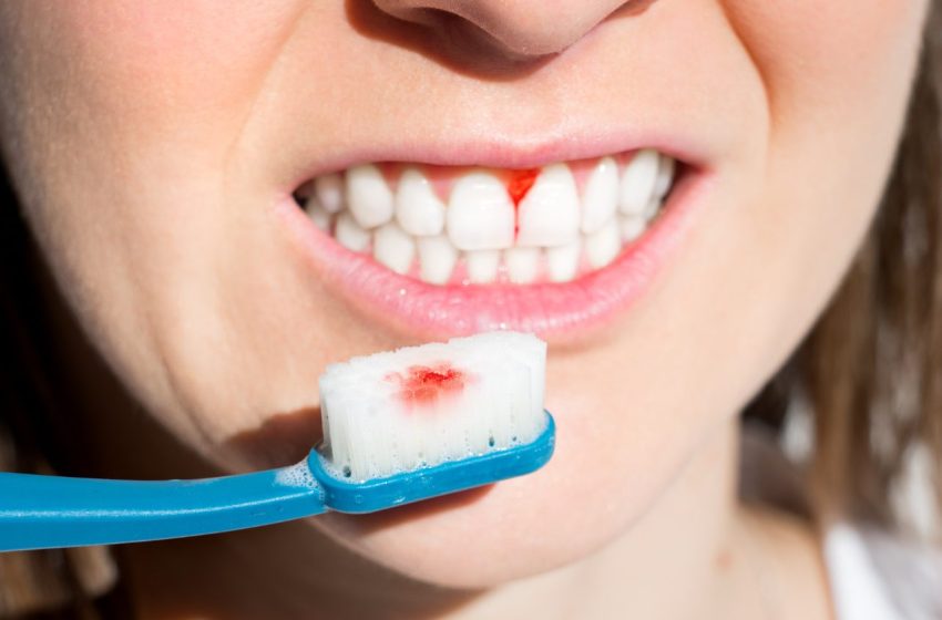  How To Treat Gum Disease: Complete Guide 2023
