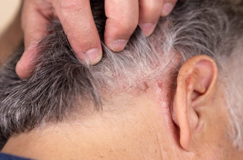  8 Remedies for Managing Scalp Psoriasis: Complete Guide 2023