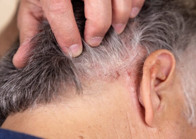 scalp psoriasis