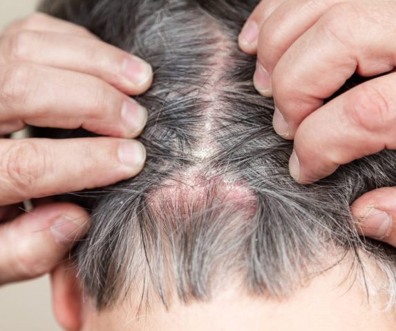 scalp psoriasis